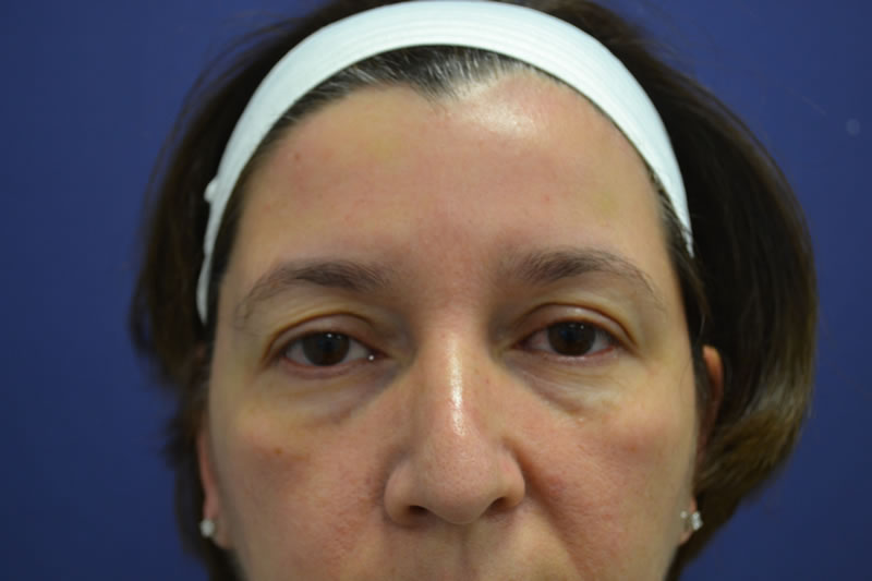 Blepharoplasty