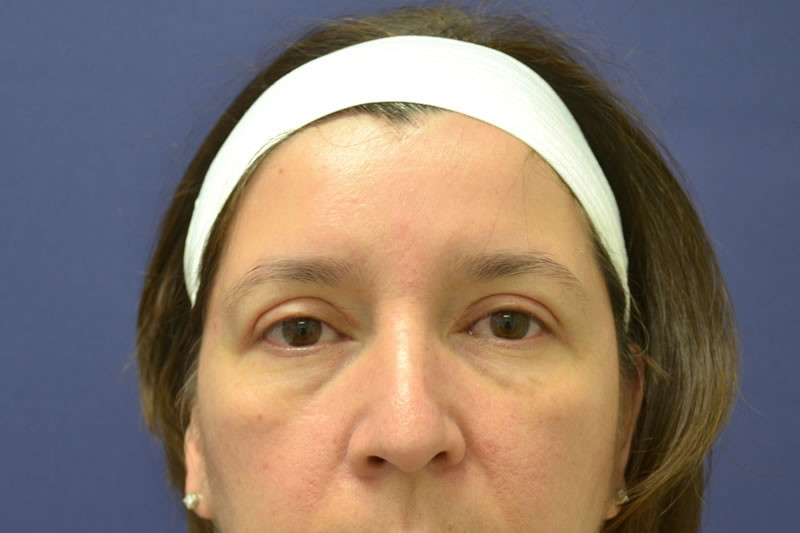 Blepharoplasty