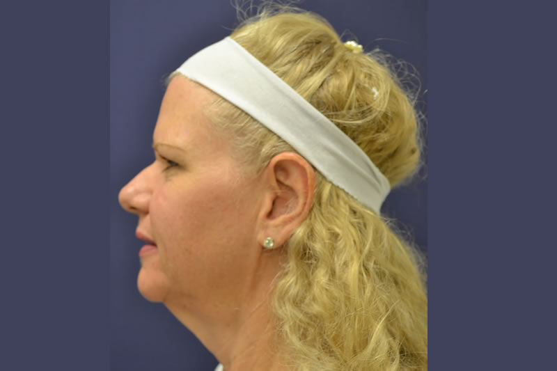 Face Lift