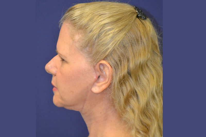 Face Lift