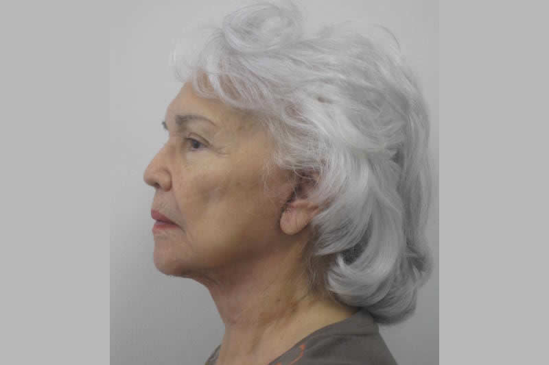 Face Lift