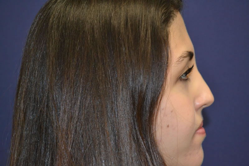 Rhinoplasty