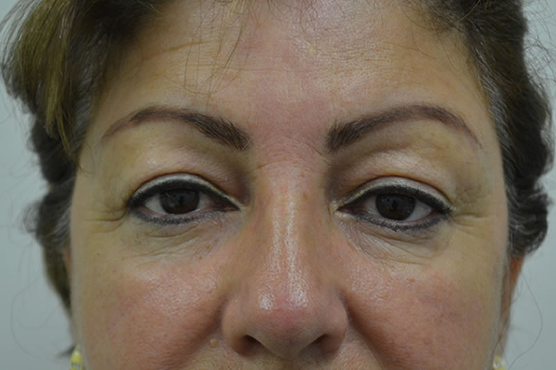 Blefaroplastia