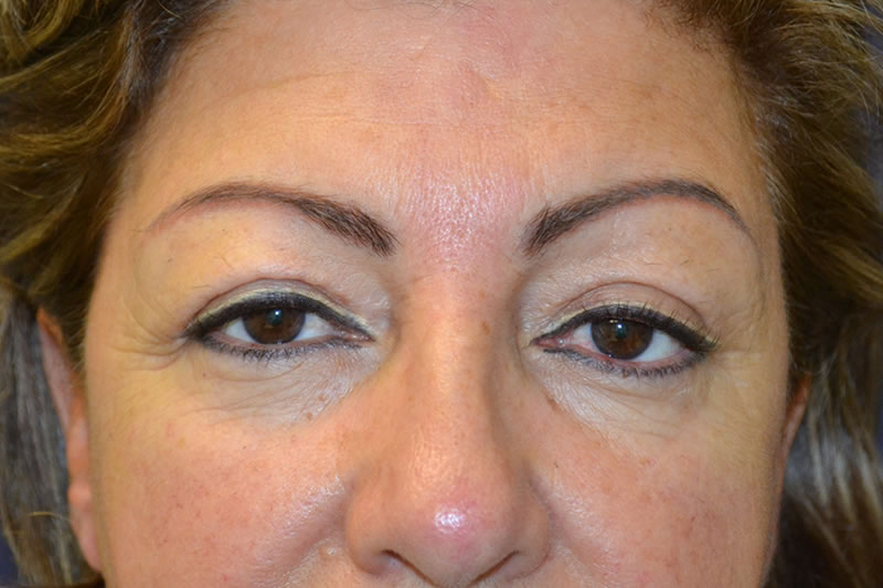 Blefaroplastia