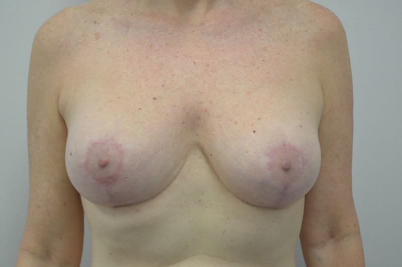 Breast Lift (Mastopexy)