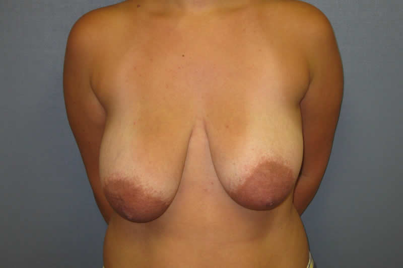 Breast Lift (Mastopexy)