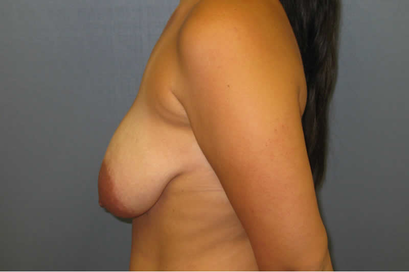 Breast Lift (Mastopexy)