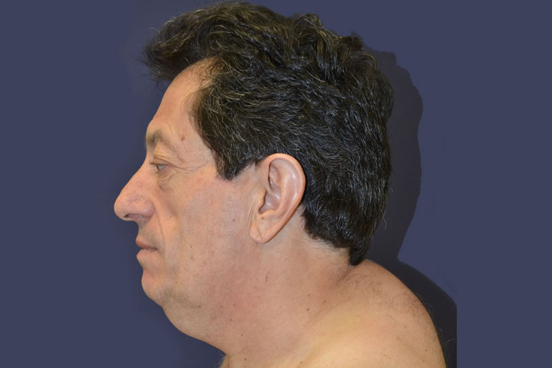 Liposucción Liposucción