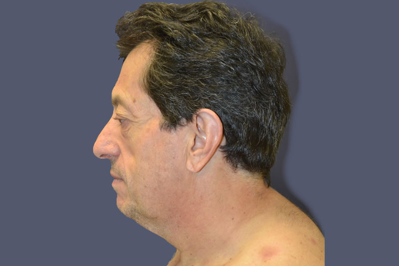 Liposucción Liposucción
