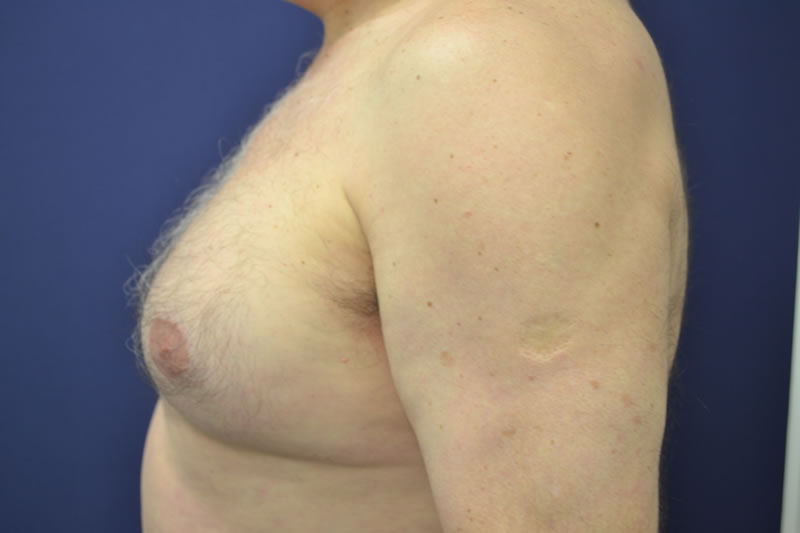 Liposucción Liposucción