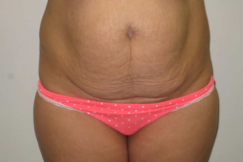 Abdominoplastia