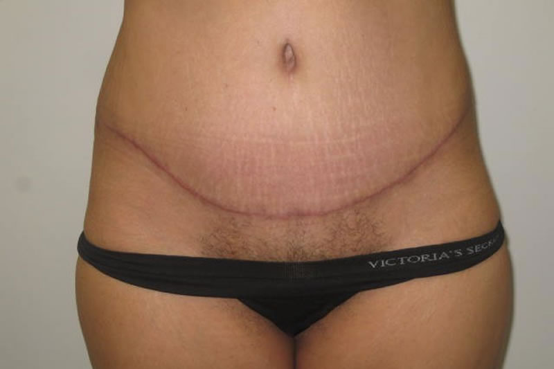 Abdominoplastia