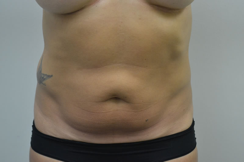 Abdominoplastia