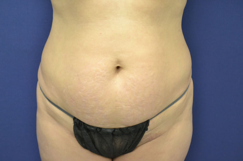 Abdominoplastia