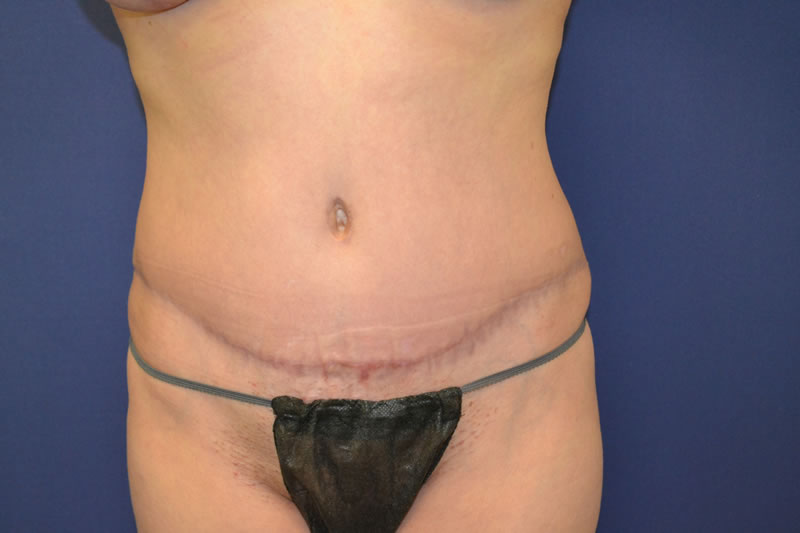 Abdominoplastia