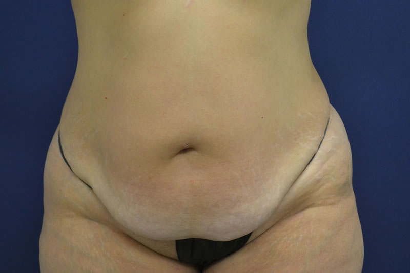 Abdominoplastia