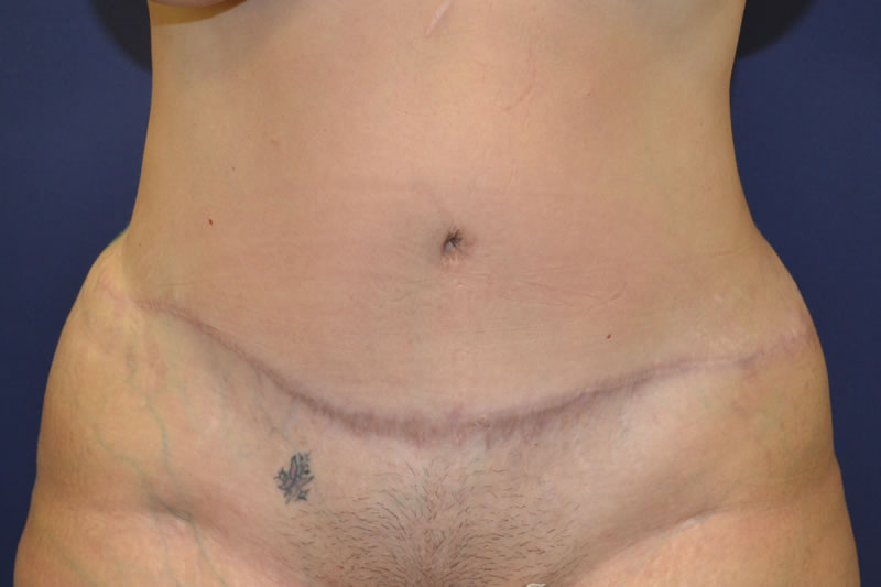 Abdominoplastia