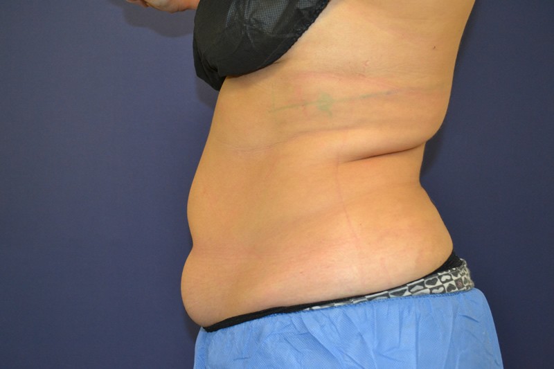 Coolsculpting