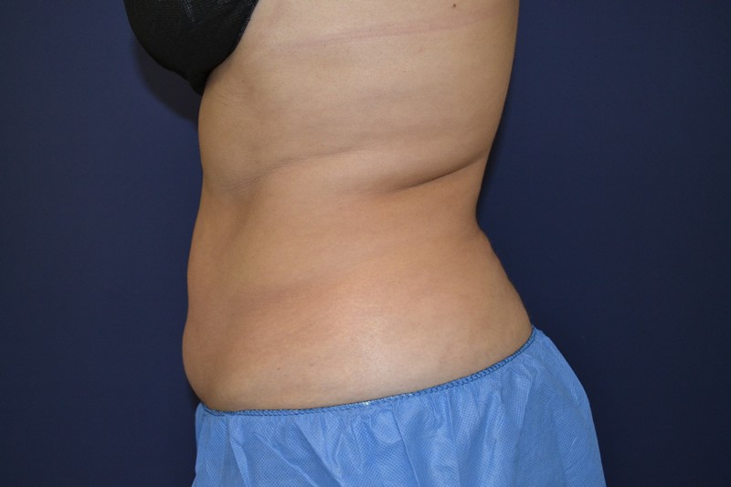 Coolsculpting