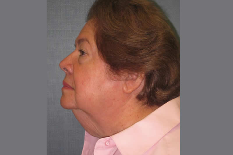 Neck Lift 