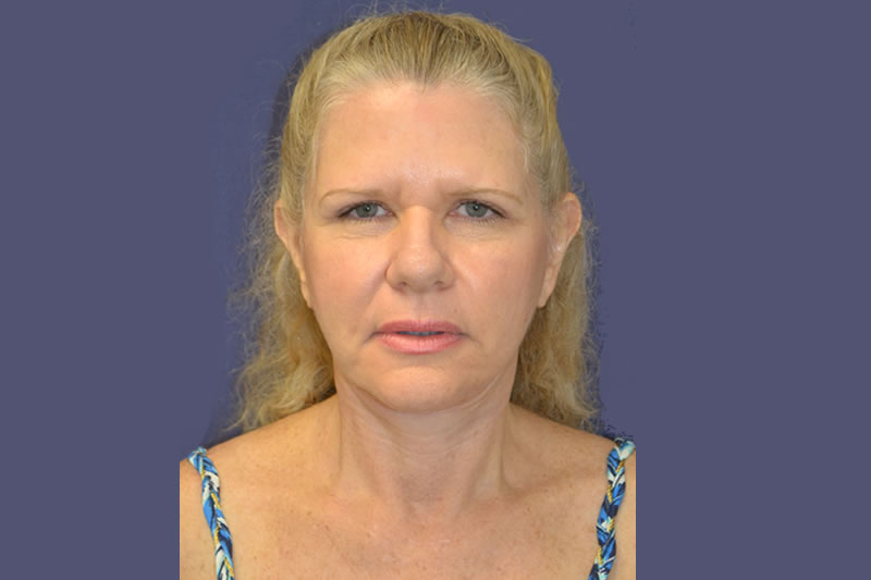 Face Lift