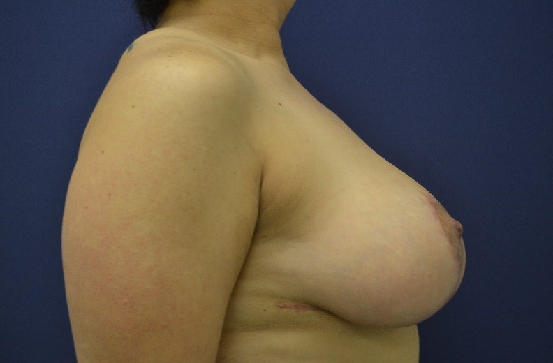 Breast Reduction