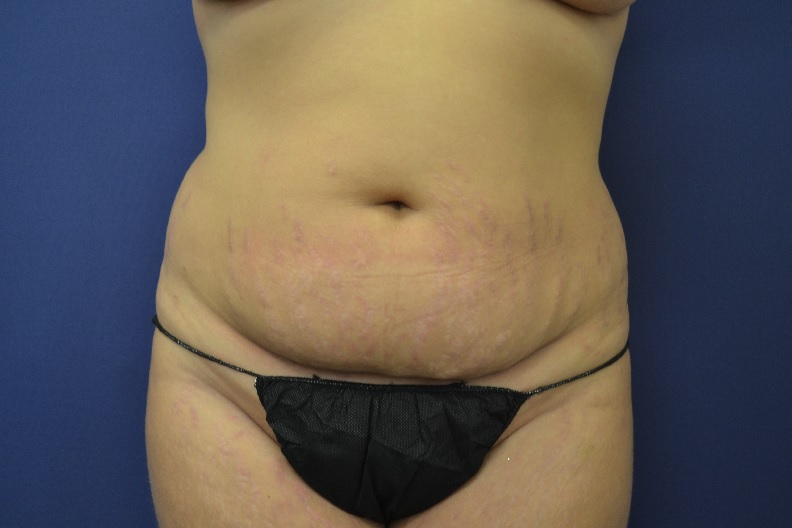 Abdominoplastia