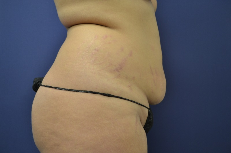 Abdominoplastia