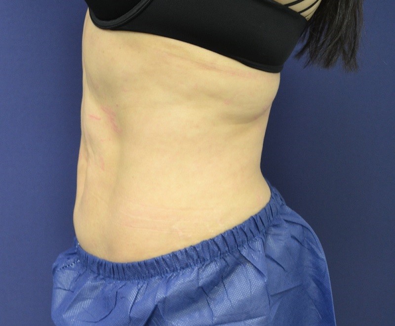 Coolsculpting