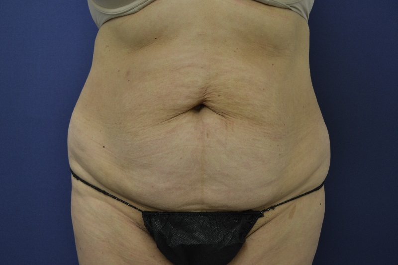 Abdominoplastia