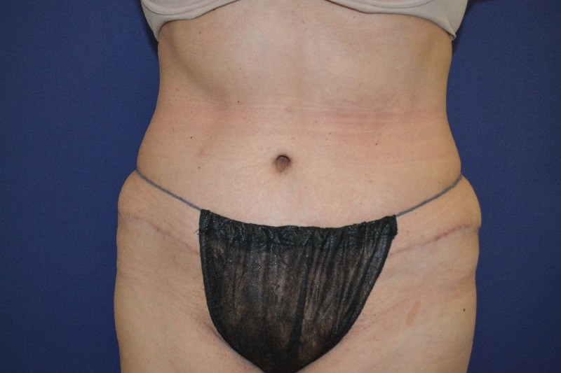 Abdominoplastia