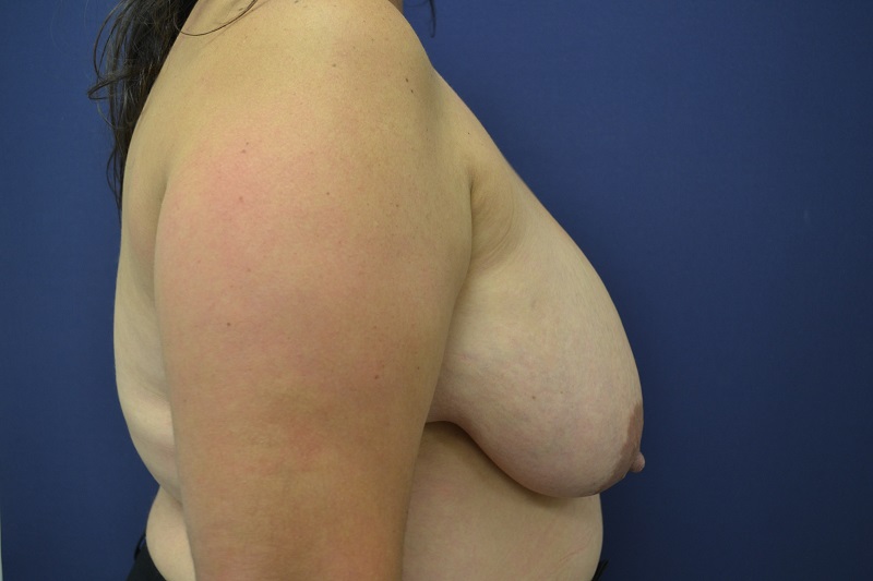 Breast Reduction