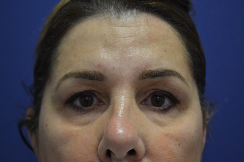 Blefaroplastia