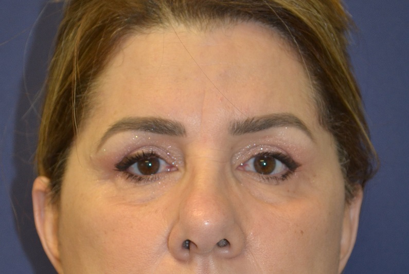 Blepharoplasty