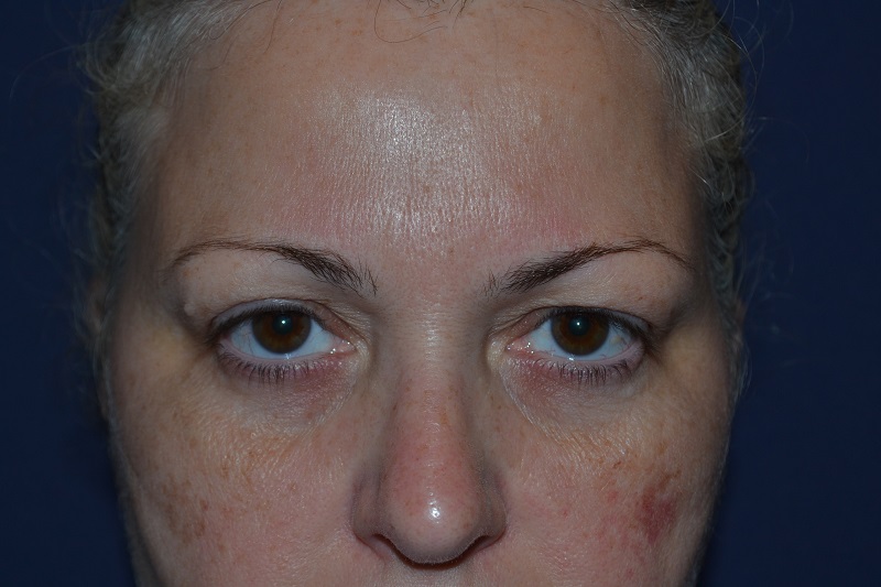 Blefaroplastia