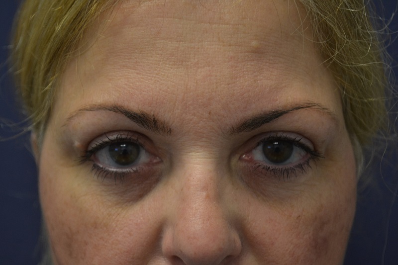 Blepharoplasty